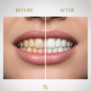 ¡ЅUРЕR ОFЕRТА! - Blanqueador Dental Portatil WhiteLux